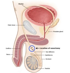 Wazektomia