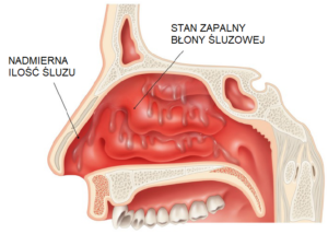 niedrożność nosa