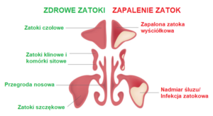 zapalenie zatok