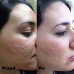 Dermapen efekty 1
