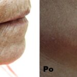 Dermapen efekty 2