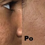 Dermapen efekty 3