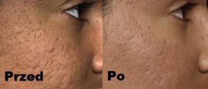 Dermapen efekty 3