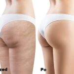 Endermologia LPG efekty 1