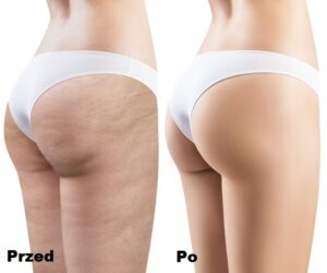 Endermologia LPG efekty 1