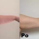 Kriolipoliza Clatuu efekty 1