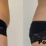 Kriolipoliza Clatuu efekty 2