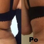 Kriolipoliza Clatuu efekty 3