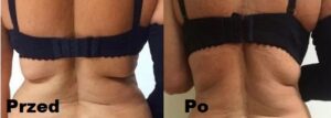 Kriolipoliza Clatuu efekty 3