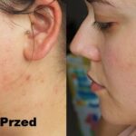 Kwas glikolowy efekty 1