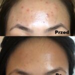 Kwas glikolowy efekty 2