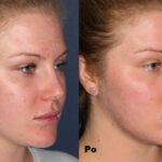 Kwas migdałowy efekty 1