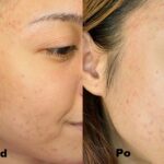 Kwas migdałowy efekty 2