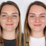 Kwas migdałowy efekty 3