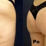 Mezoterapia przy użyciu witamin i koktajli odżywczych efekty