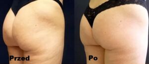 Mezoterapia przy użyciu witamin i koktajli odżywczych efekty 1