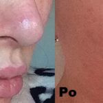 Peeling chemiczny efekty 2