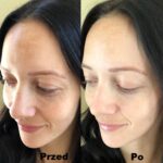 Peeling chemiczny efekty 3