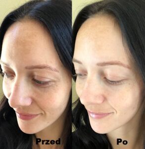 Peeling chemiczny efekty 3
