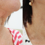 Harmony XL PRO ClearLift efekty 2