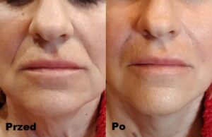 Intraceuticals Boosters kolagen efekty 1
