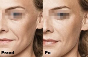 Intraceuticals Boosters kolagen efekty 3
