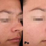 Intraceuticals - Boosters witamina A efekty 1
