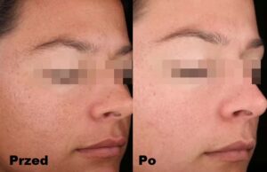 Intraceuticals - Boosters witamina A efekty 1