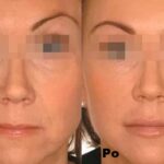 Intraceuticals - Boosters witamina A efekty 3