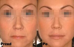 Intraceuticals - Boosters witamina A efekty 3
