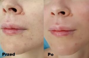 Intraceuticals - Boosters Witamina C efekty 1