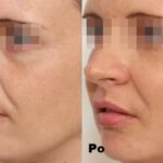 Intraceuticals - Boosters Witamina C efekty 2