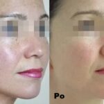 Intraceuticals - Boosters Witamina C efekty 3