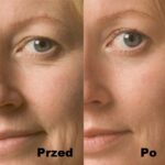 Intraceuticals Infuzja Opulence efekty 1