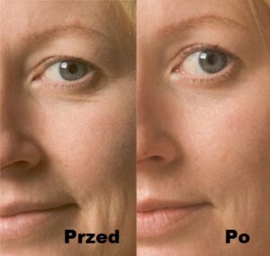 Intraceuticals Infuzja Opulence efekty 1