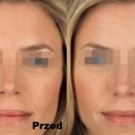 Intraceuticals Infuzja Opulence efekty 2