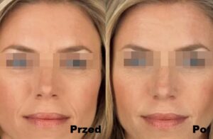 Intraceuticals Infuzja Opulence efekty 2