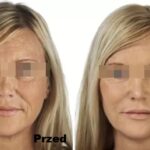Intraceuticals Infuzja Opulence efekty 3