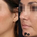 Intraceuticals - Rejuvenate efekty 1