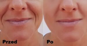 Intraceuticals - Rejuvenate efekty 2