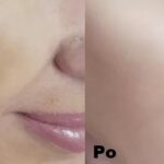 Intraceuticals - Rejuvenate efekty 3