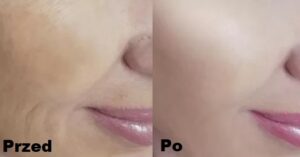 Intraceuticals - Rejuvenate efekty 3