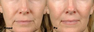 Intraceuticals Thermal Water efekty 2