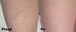 Laser Harmony Baby Rejuve Long Pulsed Nd:YAG 1064 nm efekty 2