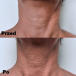 Mezoterapia ciała efekty 1