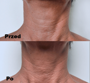 Mezoterapia ciała efekty 1