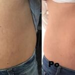 Mezoterapia ciała efekty 3