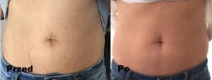Mezoterapia ciała efekty 3